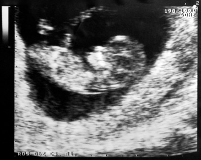 Ultraschallbild 11. Schwangerschaftswoche - 