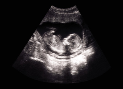  Ultraschallbild Schwangerschaftswoche 14