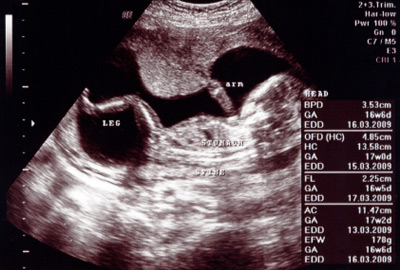 Ultraschall 17, Schwangerschaftswoche