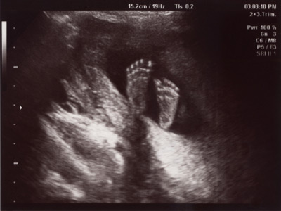Ultraschallbild 18. Schwangerschaftswoche