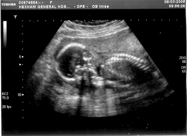 Ultraschallbild 19. Schwangerschaftswoche