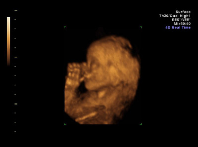 3d Ultraschallbild 21. Schwangerschaftswoche