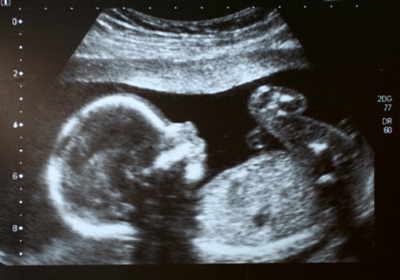 Ultraschallbild 22. Schwangerschaftswoche