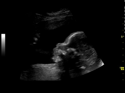 25. Schwangerschaftswohe Ultraschallbild