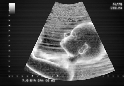 28. Schwangerschaftswohe Ultraschall