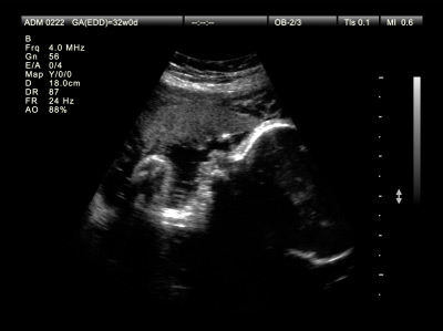 Schwangerschaftswoche 32 - Ultraschallbild