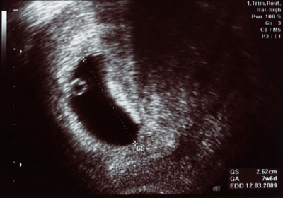 Ultraschallbild 4. Schwangerschaftswoche