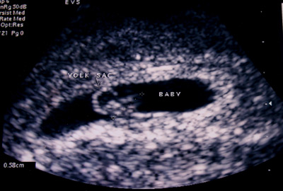 Ultraschall 5. Schwangerschaftswoche
