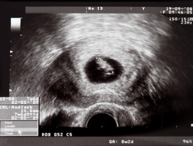 Ultraschallbild 8. Schwangerschaftswoche