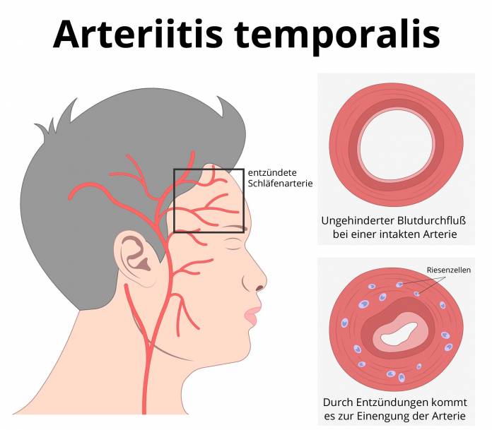 Arteriitis temporalis