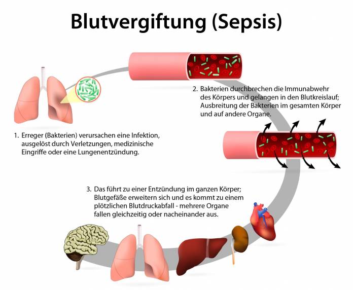 Blutvergiftung (Sepsis)