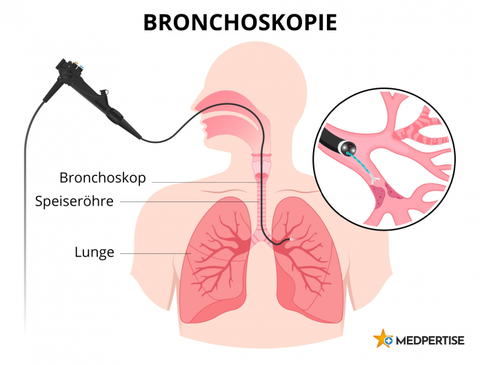 Bronchoskopie
