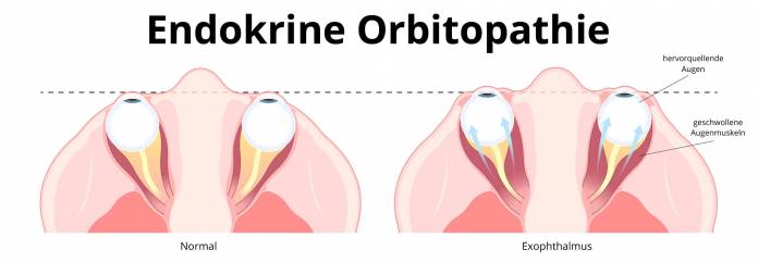 Endokrine Orbitopathie