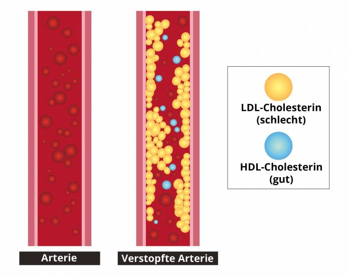 HDL und LDL-Cholesterin