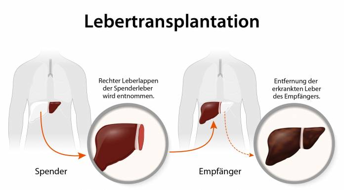 Lebertransplantation