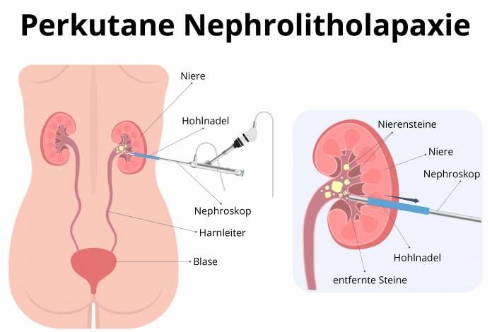 Perkutane Nephrolitholapaxie
