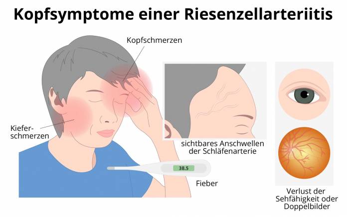 Kopfsymptome einer Riesenzellarteriitis