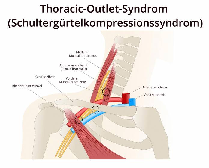 Thoracic-Outlet-Syndrom (Schultergürtelkompressionssyndrom)