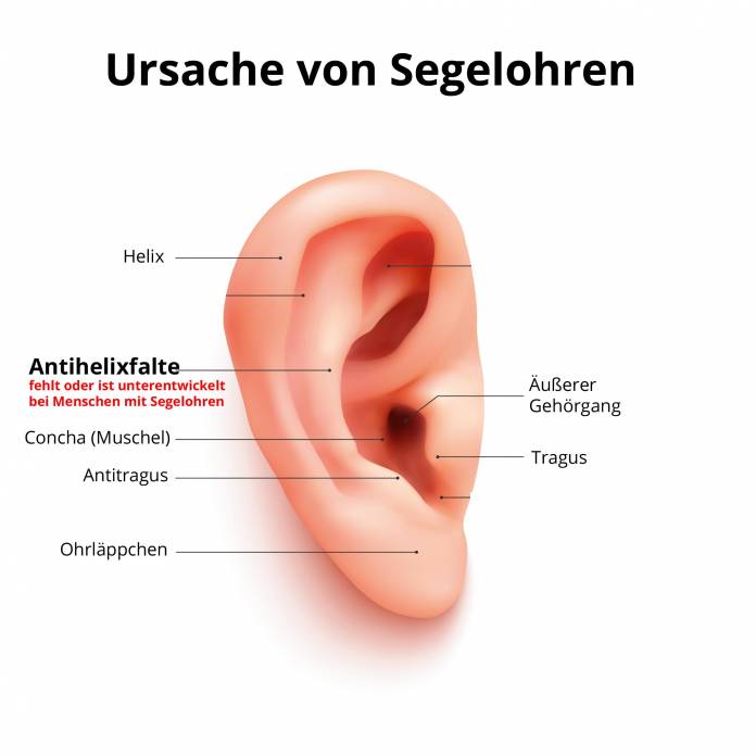 Ursache abstehender Ohren