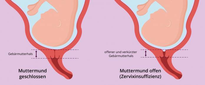 Zervixinsuffizienz (Muttermund offen)