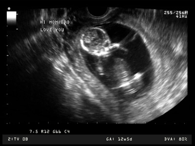 Ultraschallbild 12. Schwangerschaftswoche