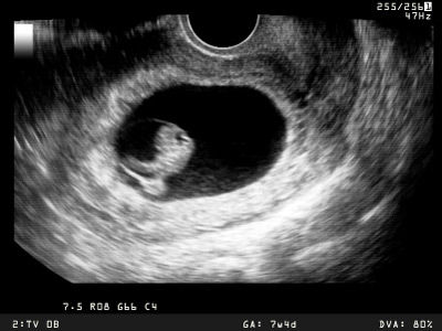 Ultraschallbild Schwangerschaftswoche 7