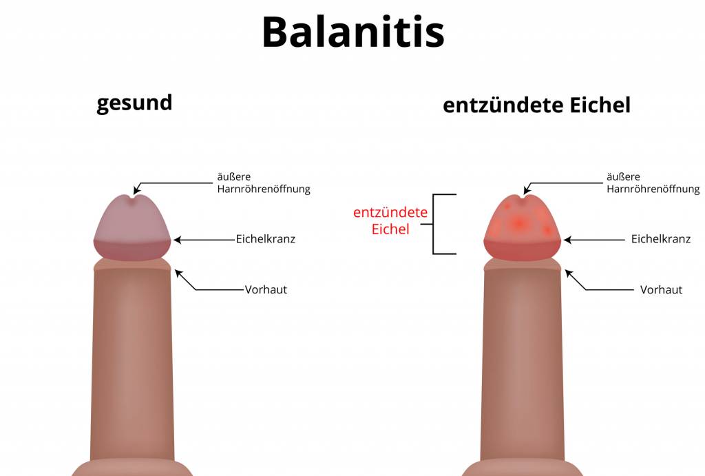 Balanitis simplex