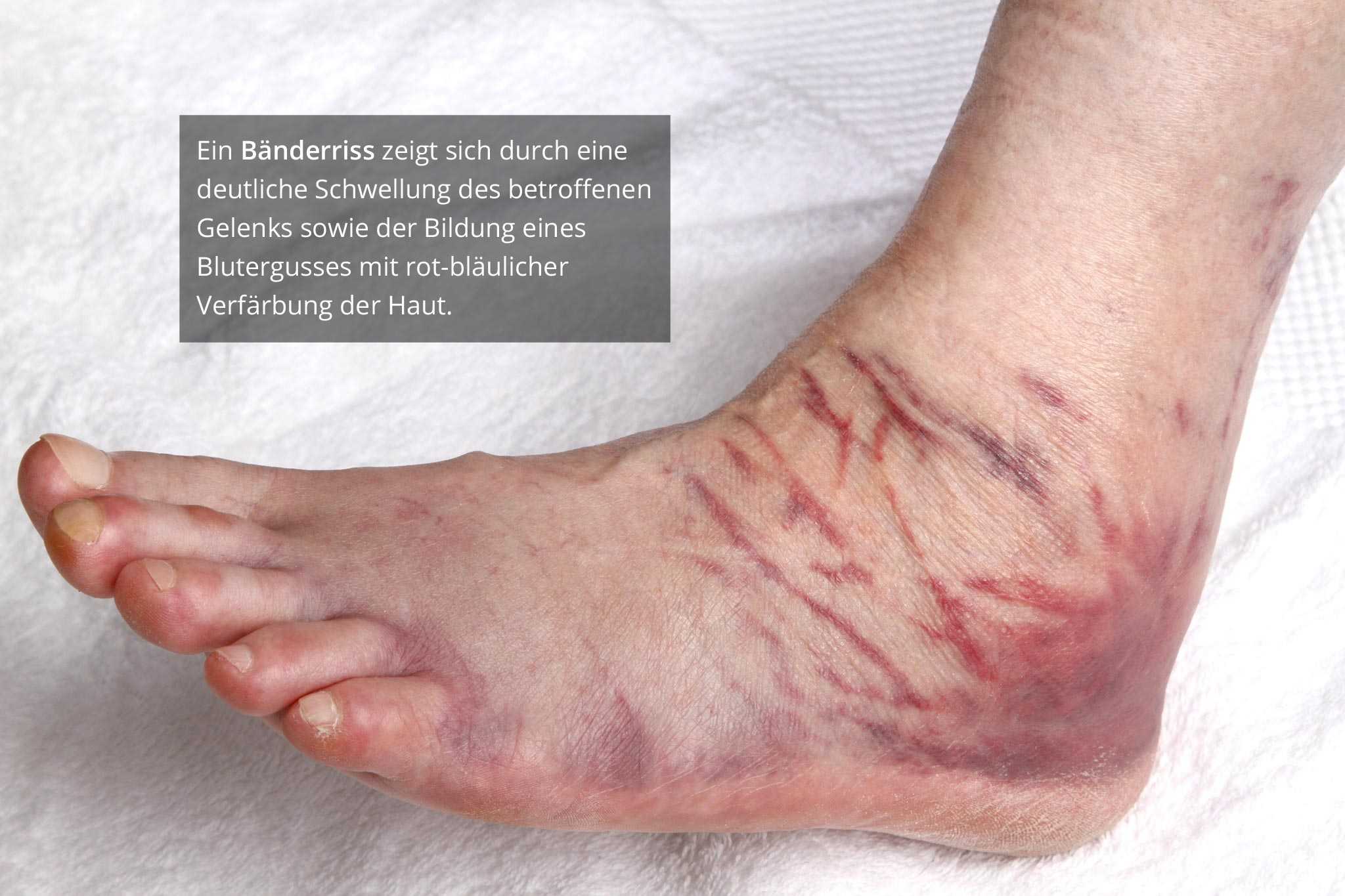 Bänderriss Fuß Symptome