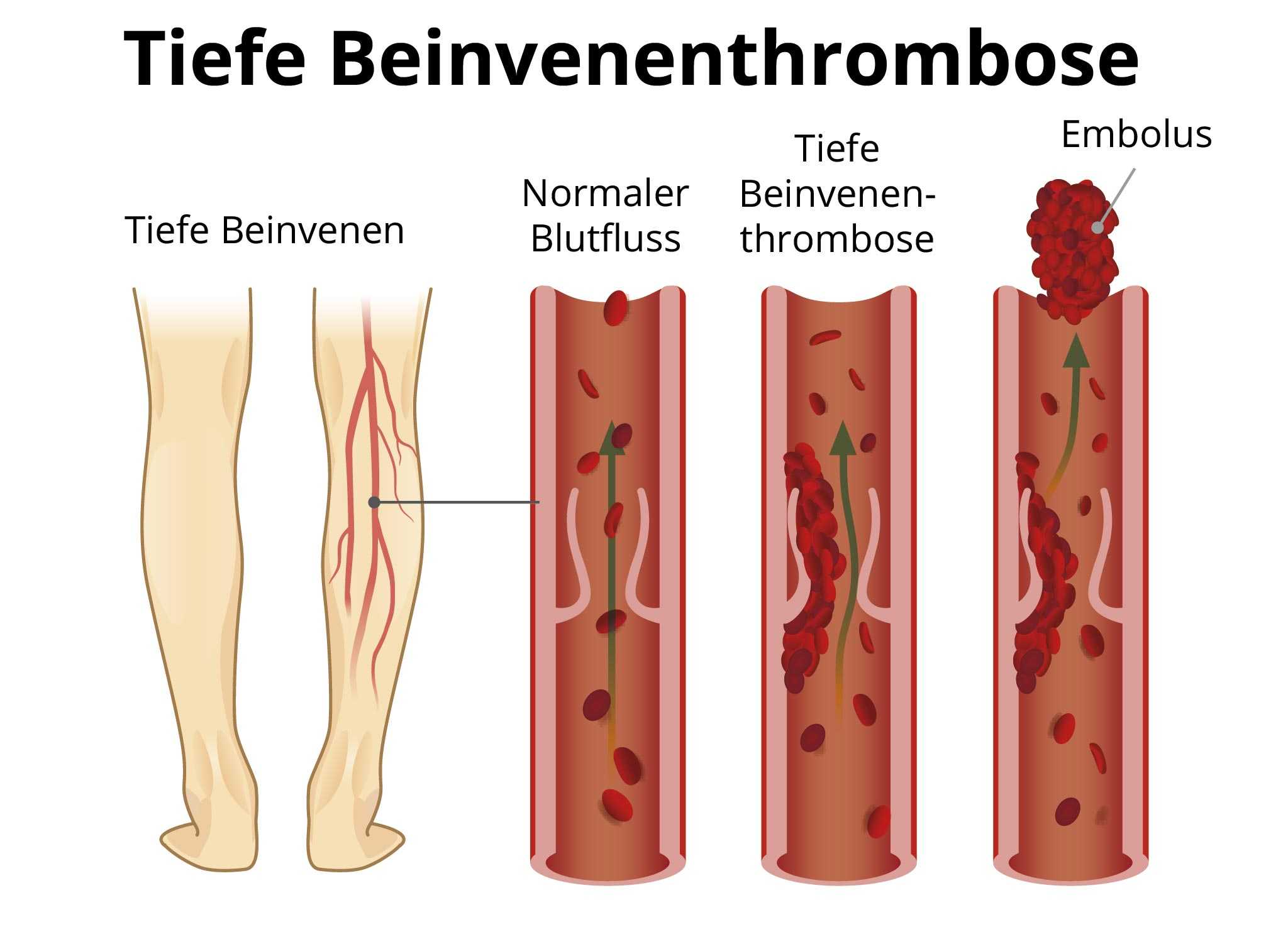 Symptome Bei Thrombose