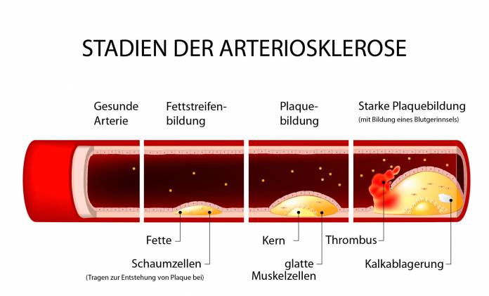 Stadien der Arteriosklerose