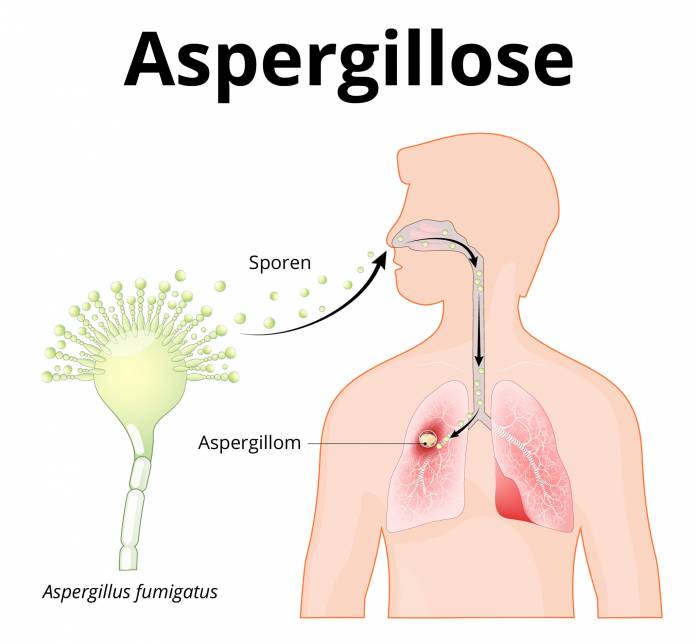 Aspergillose