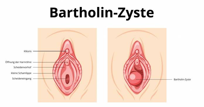 Bartholin-Zyste