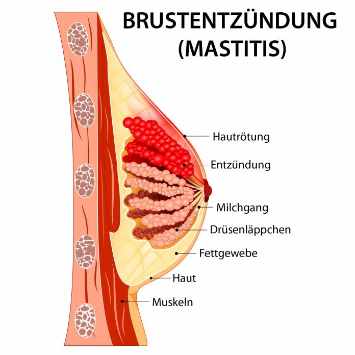 Brustentzündung (Mastitis)