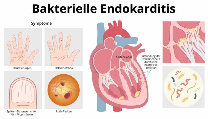 Bakterielle Endokarditis