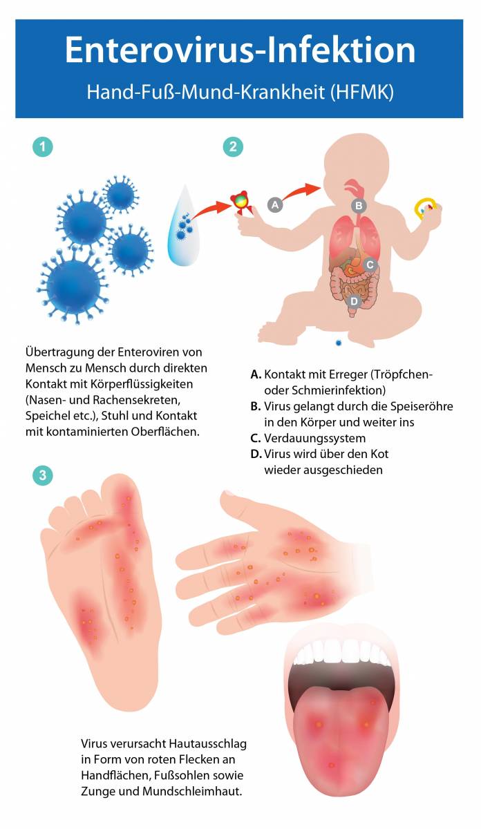 Enterovirus Infektion (Hand-Fuß-Mund-Krankheit)