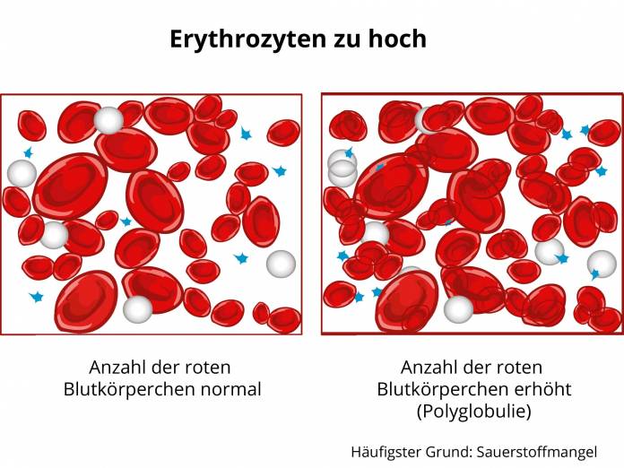 Erythrozyten zu hoch - Polyglobulie