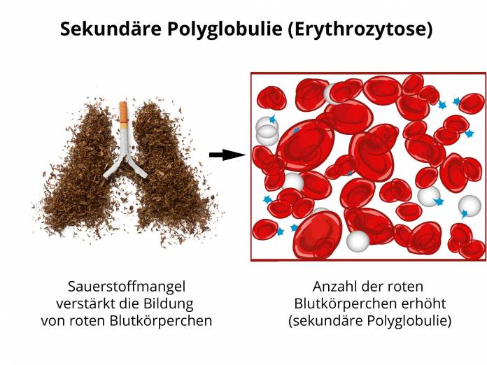 Erythrozytose (sekundäre Polyglobulie)
