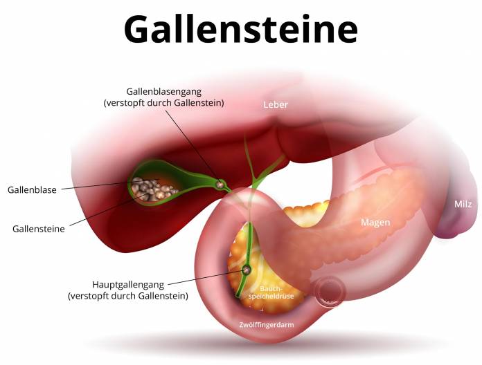 Gallensteine