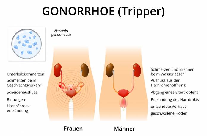 Symptome bei Gonorrhoe (Tripper)