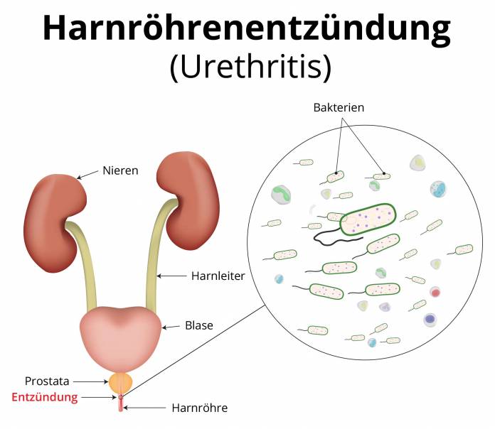 Harnröhrenentzündung (Urethritis)