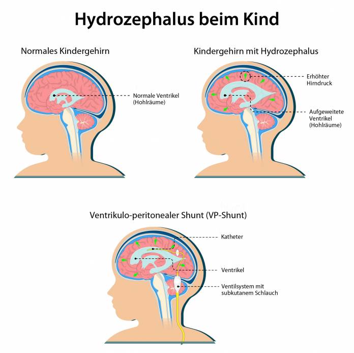 Hydrozephalus Kind