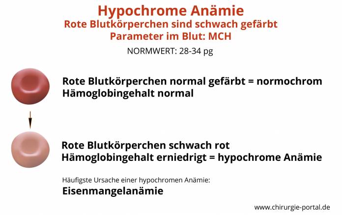 Hypochrome Anämie