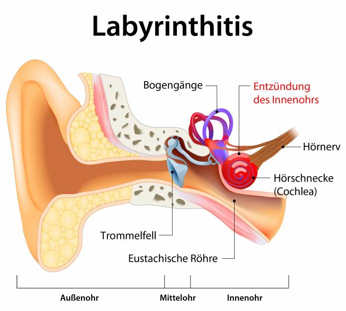 Labyrinthitis (Innenohrentzündung)