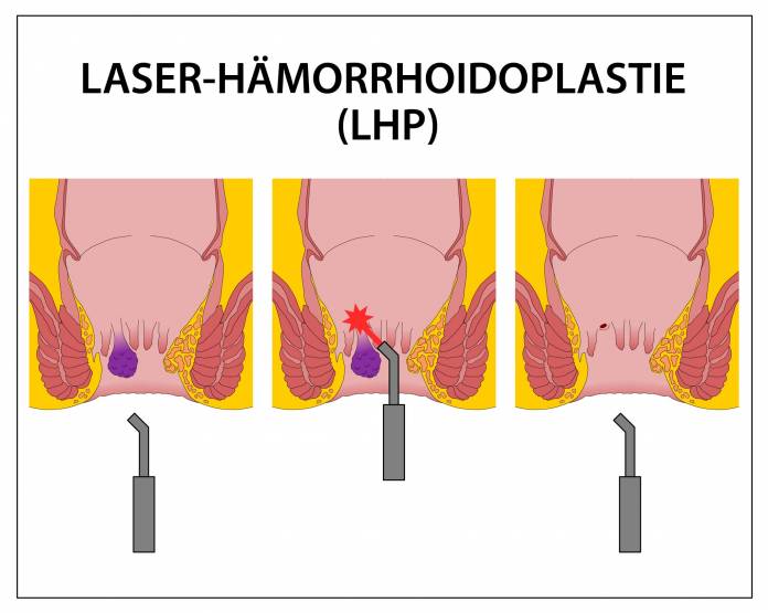 Laserhämorrhoidoplastie (LHP)