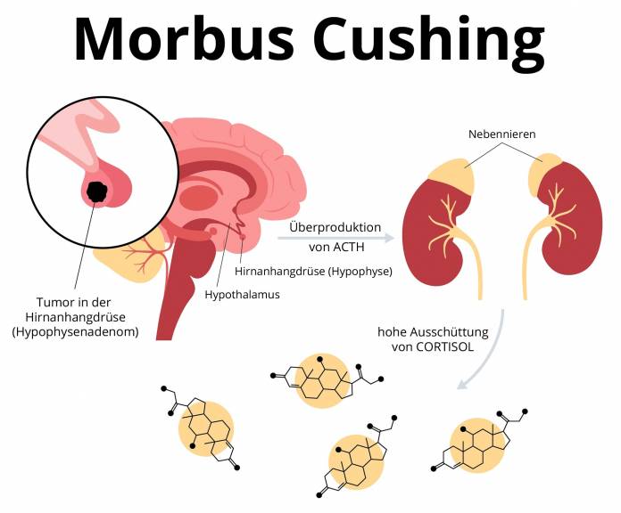 Morbus Cushing