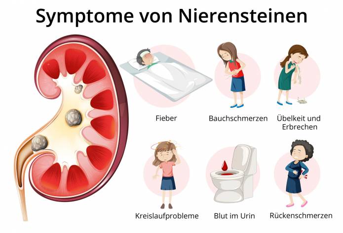 Symptome von Nierensteinen