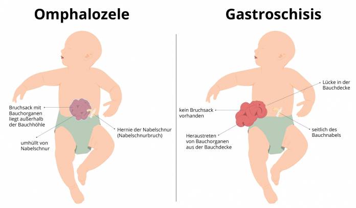 Omphalozele und Gastroschisis