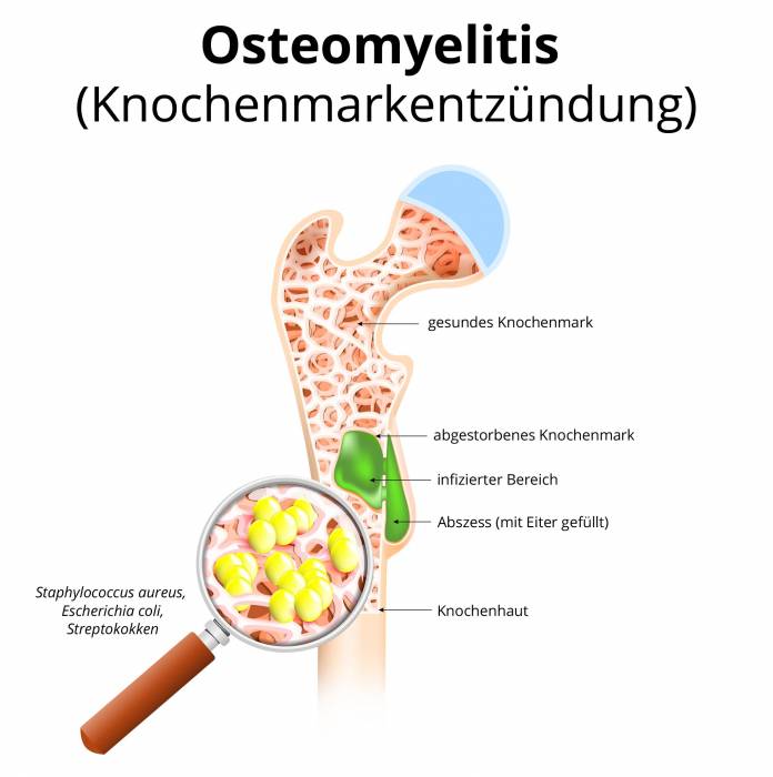 Osteomyelitis (Knochenmarkentzündung)