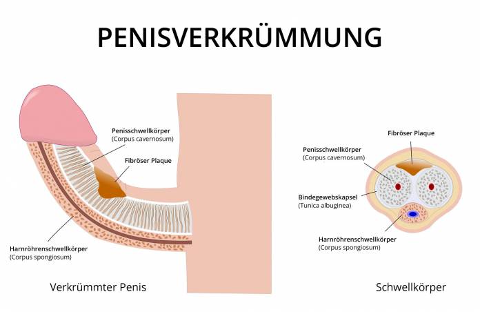 Penisverkrümmung