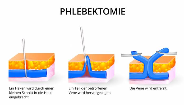 Phlebektomie